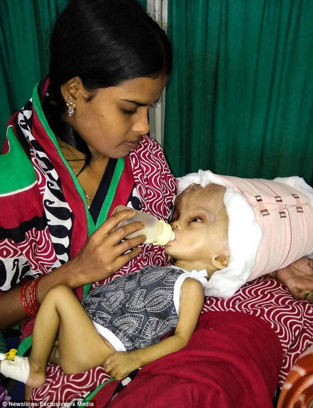 Photo Cet Enfant A La Plus Grosse Tete Du Monde A Cause D Une Maladie Une Pomme Par Jour